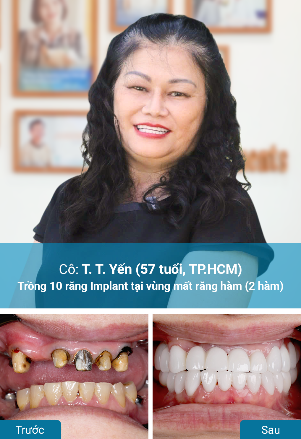 Khách hàng trồng răng Implant tại nha khoa Dr. Care