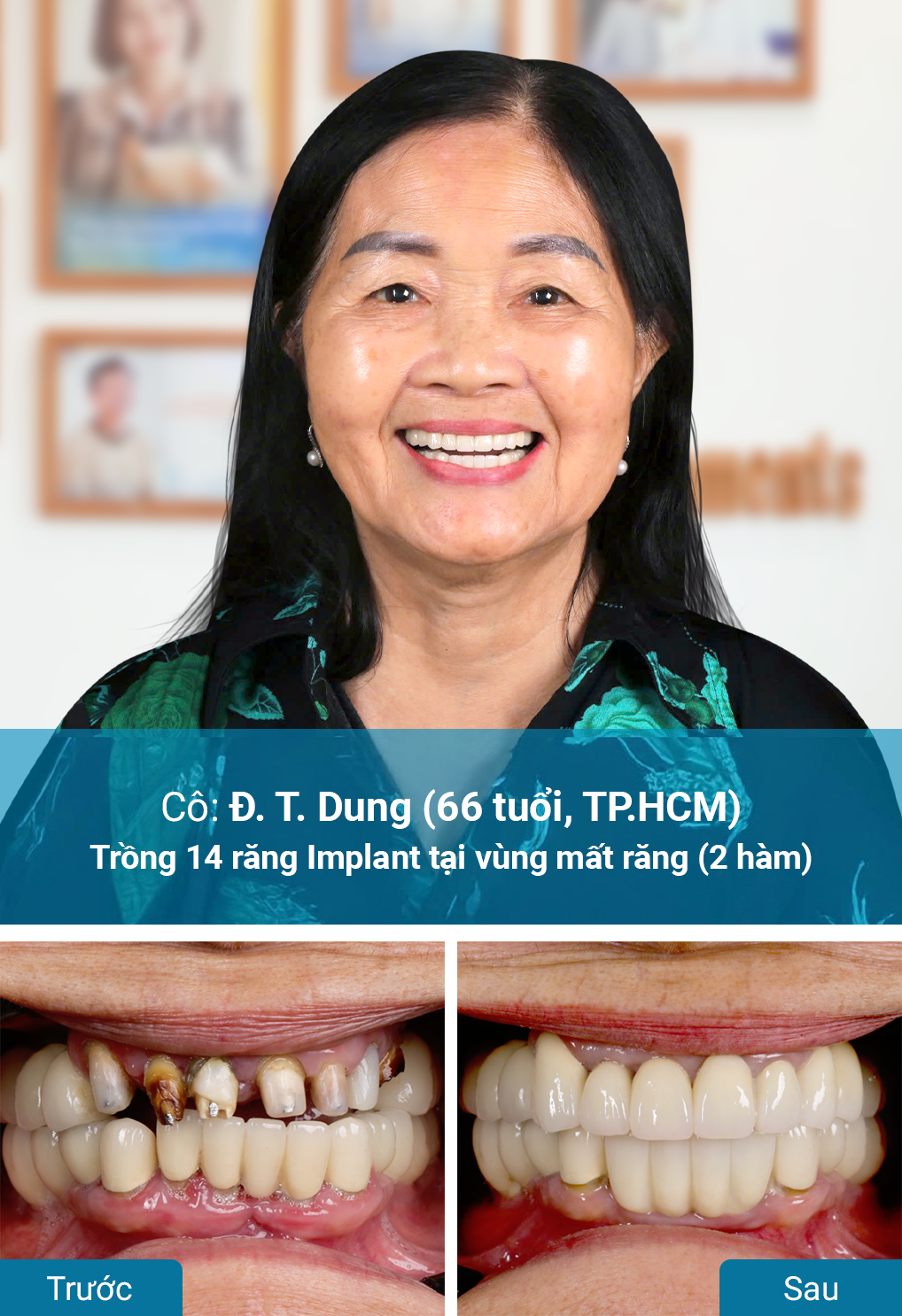 Khách hàng trồng răng Implant tại nha khoa Dr. Care