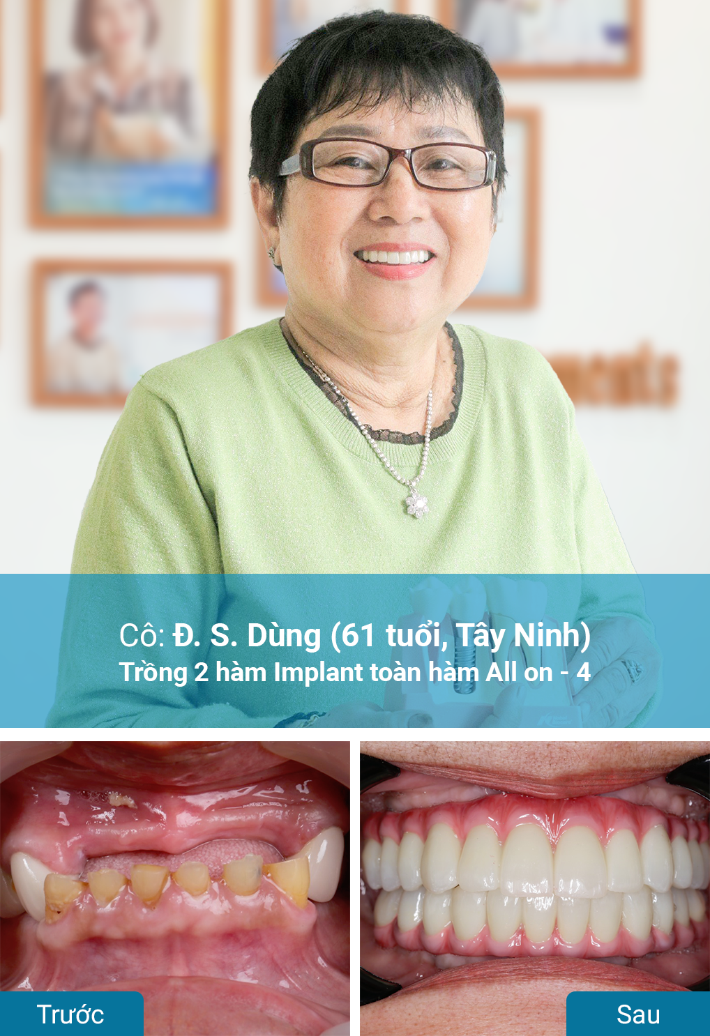 Khách hàng trồng răng Implant tại nha khoa Dr. Care