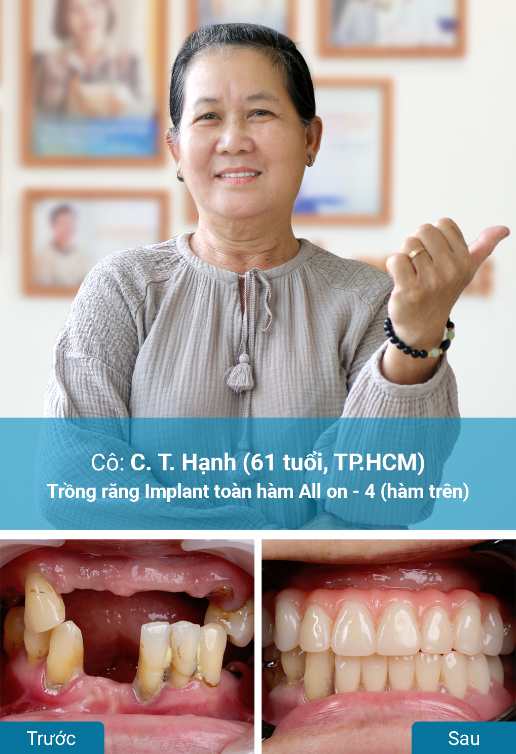 Khách hàng trồng răng Implant tại nha khoa Dr. Care