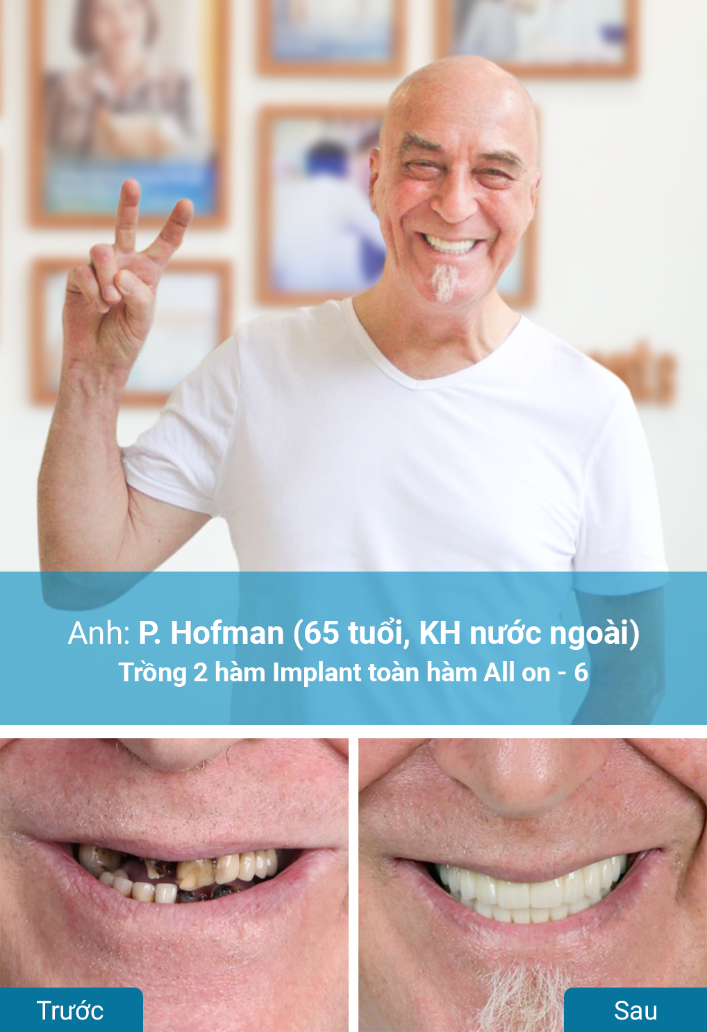 Khách hàng trồng răng Implant tại nha khoa Dr. Care