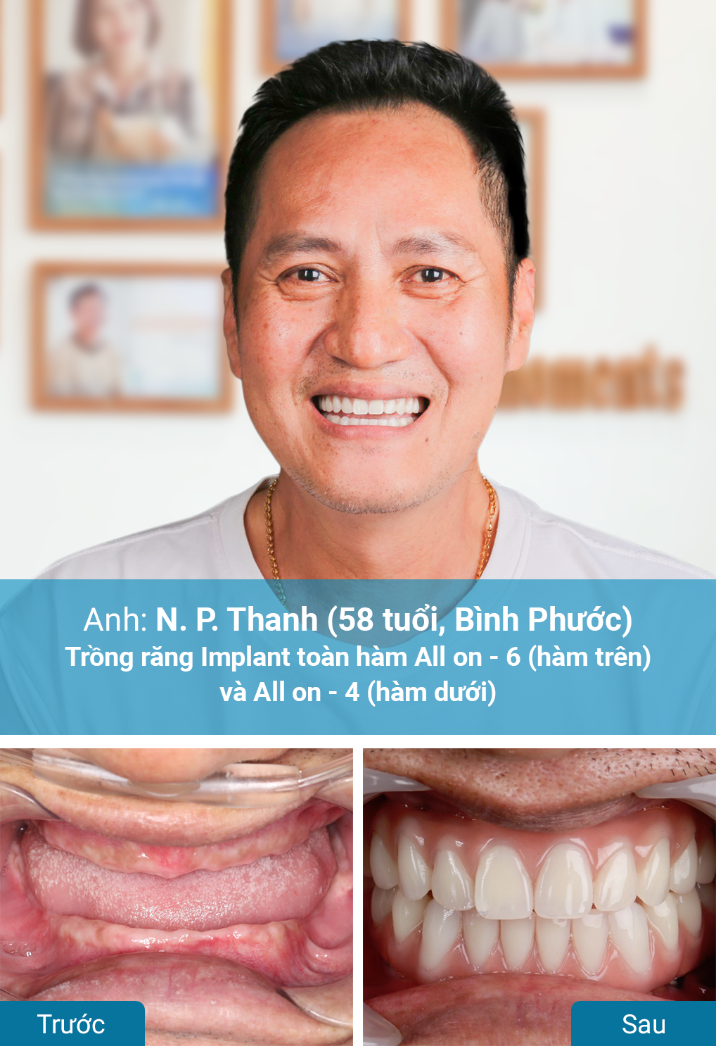 Khách hàng trồng răng Implant tại nha khoa Dr. Care