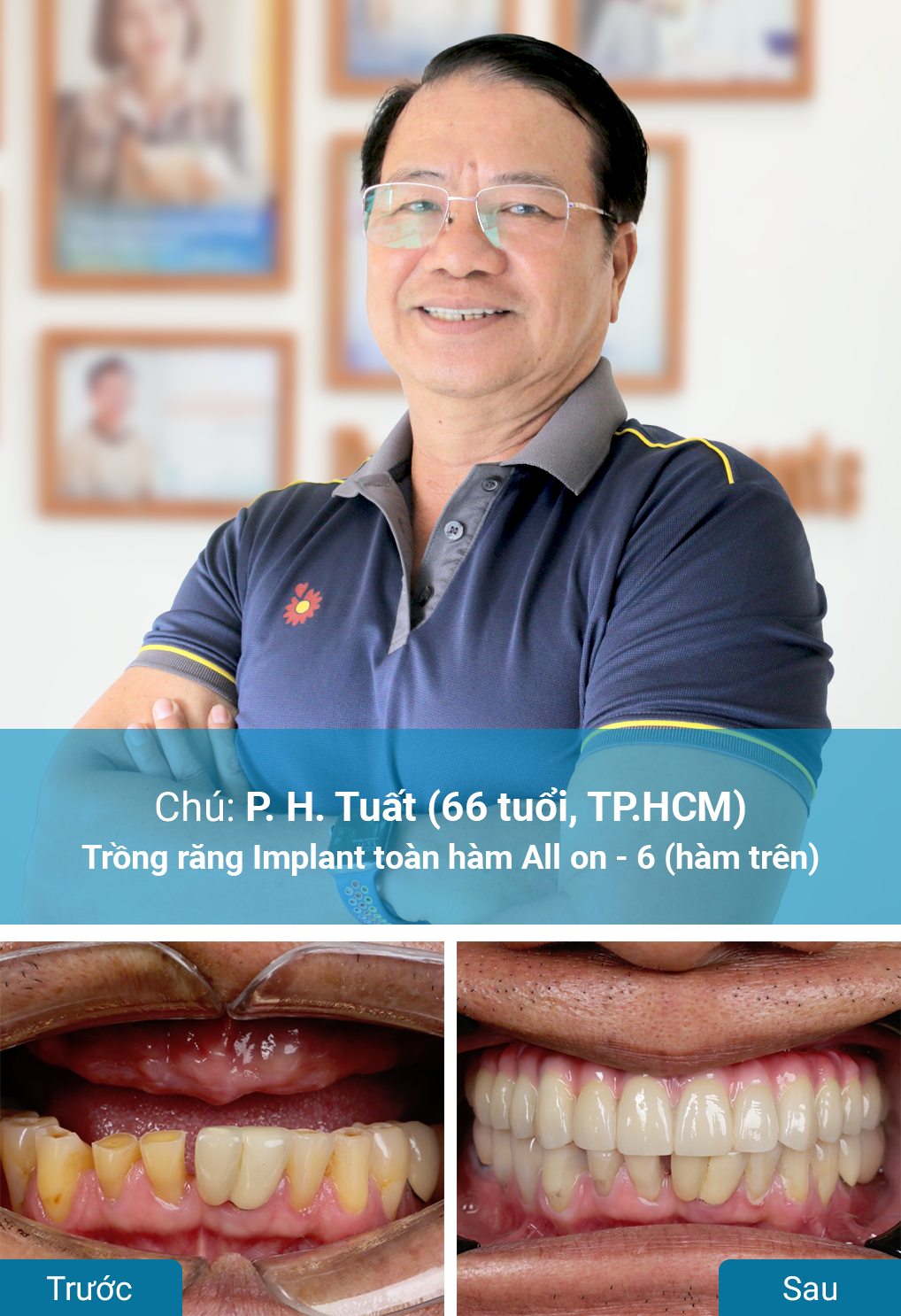 Khách hàng trồng răng Implant tại nha khoa Dr. Care