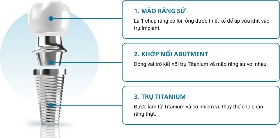 Cấu tạo của trụ Implant