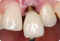 đào thải trụ Implant