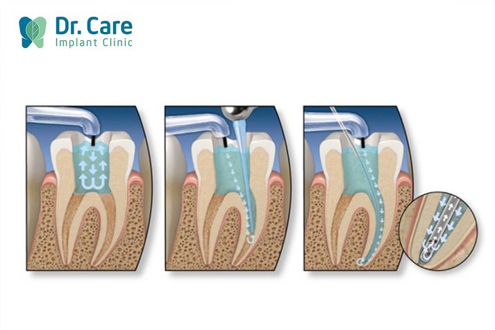 Phương pháp lấy tủy răng được thực hiện như thế nào?