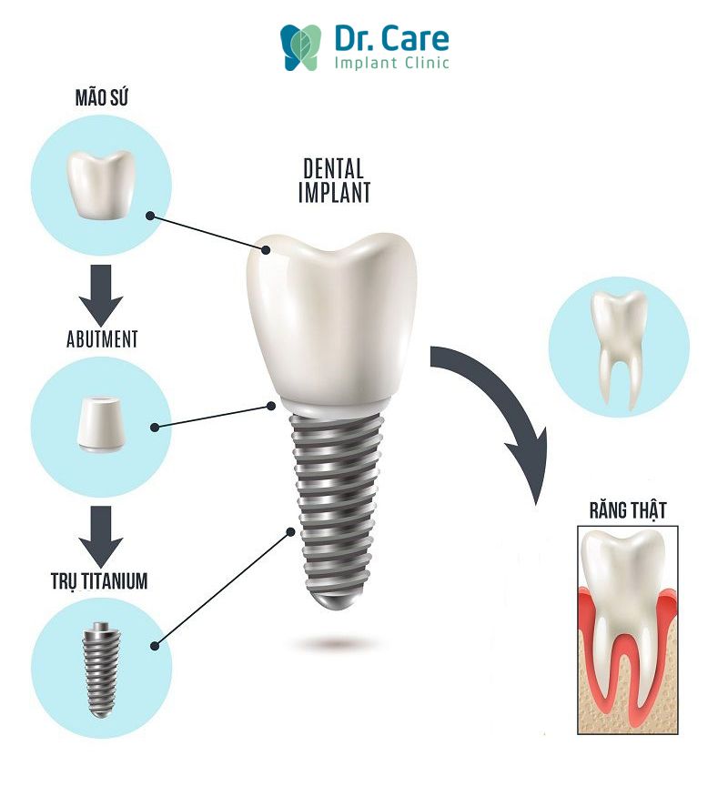 implant nha khoa