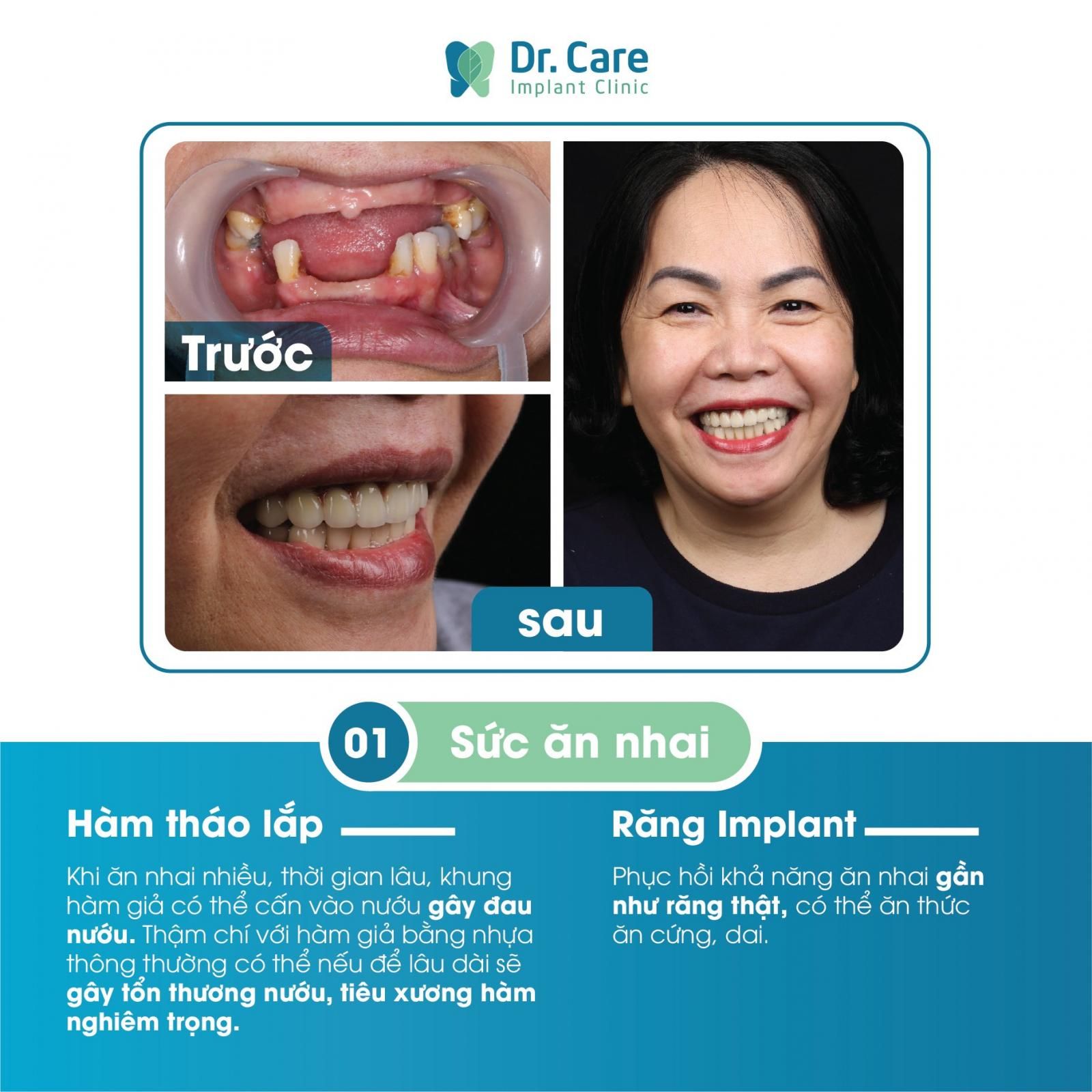 Hàm tháo lắp cổ điển với Implant