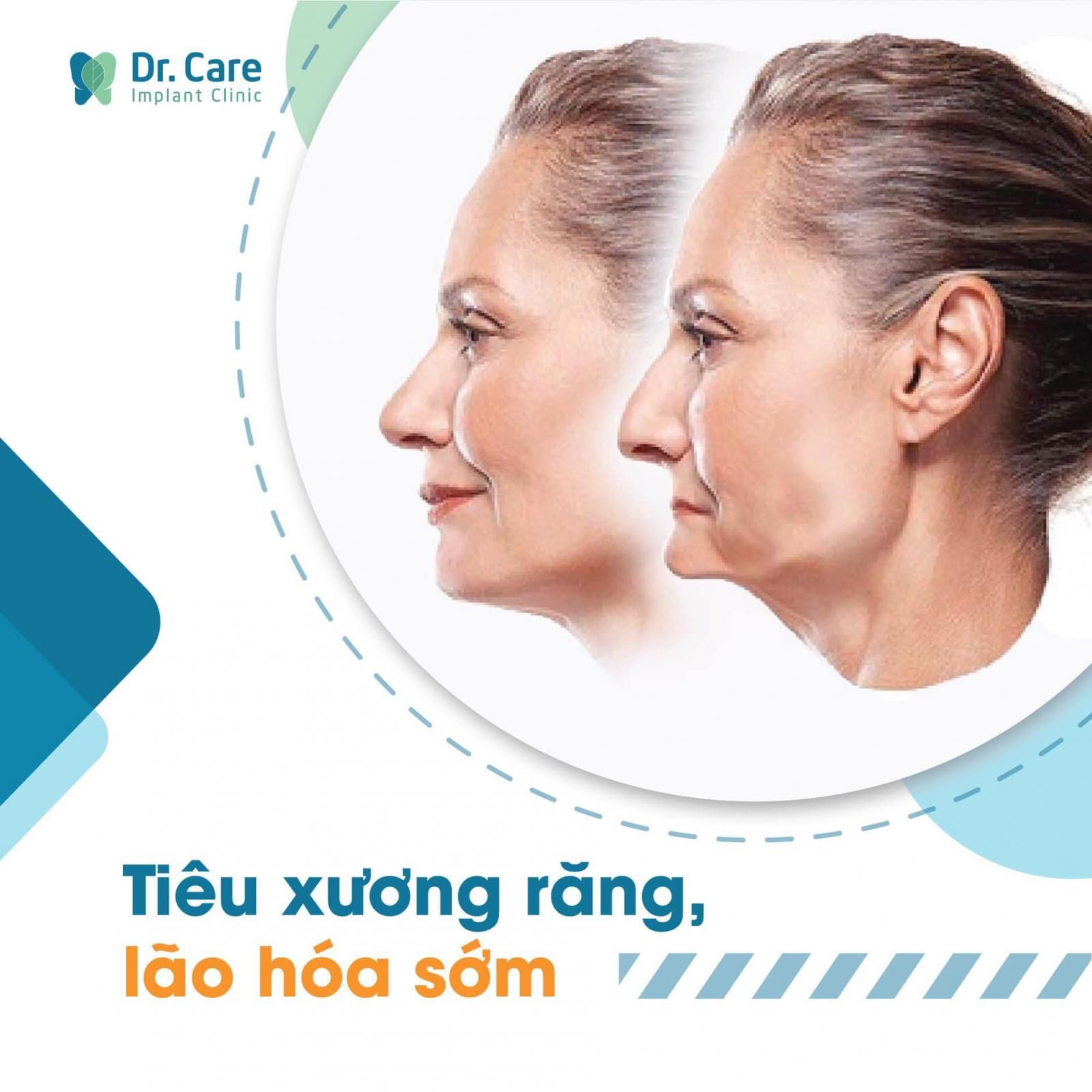 Tiêu xương hàm dẫn đến teo nướu, lão hóa sớm gương mặt do mất răng toàn hàm