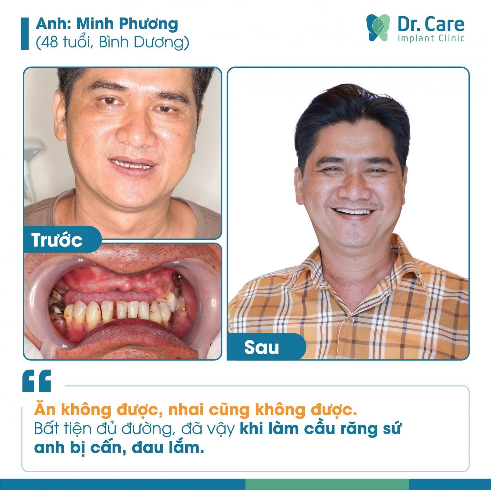 Một số câu hỏi thường gặp khi bọc răng sứ thẩm mỹ