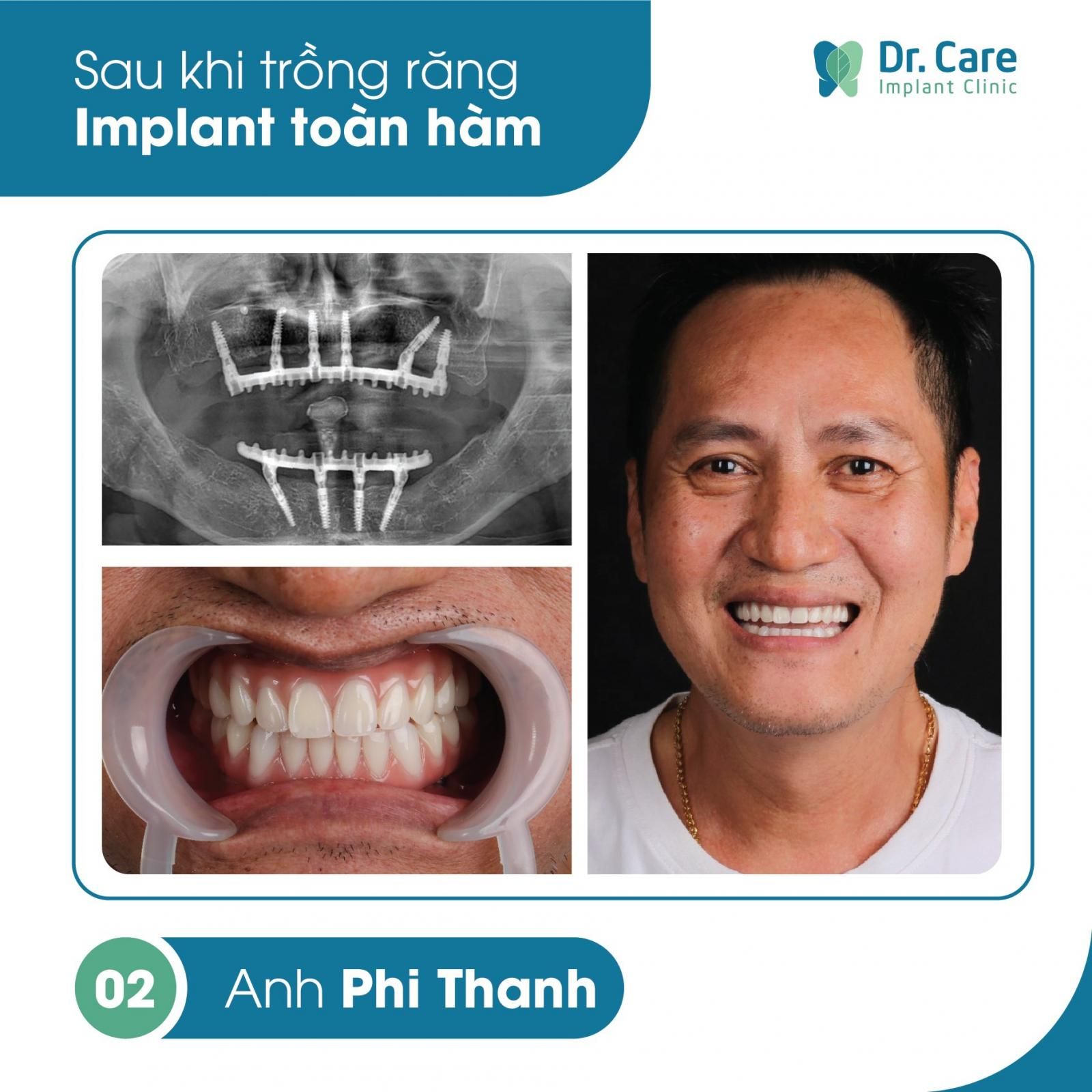 Trồng răng Implant