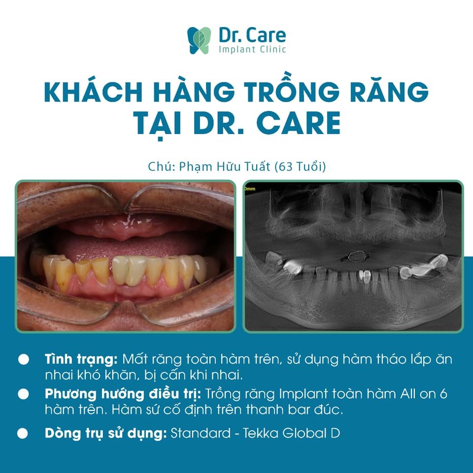 mất răng toàn hàm trồng implant