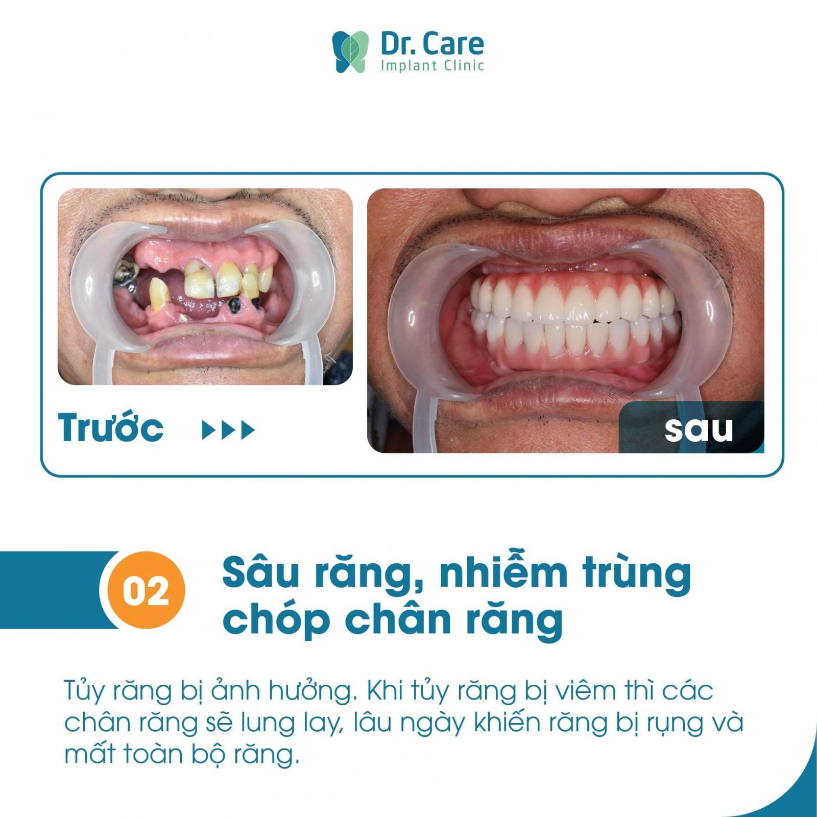 Trồng răng Implant