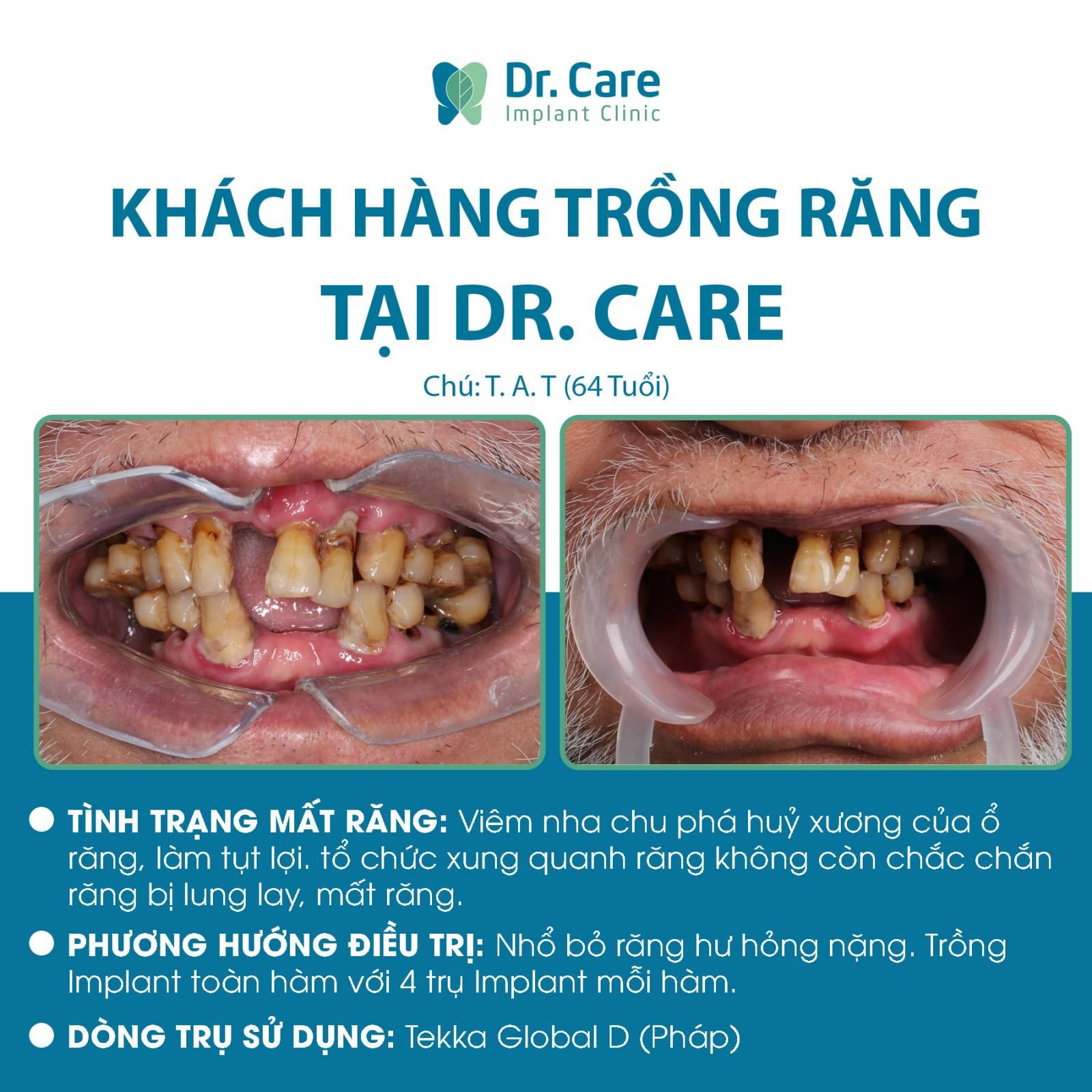  Bệnh viêm nha chu kéo dài mất răng toàn hàm