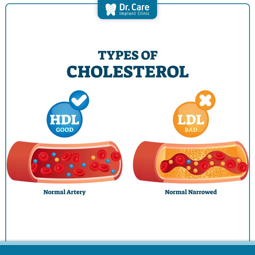 Cholesterol nghĩa là gì? Tìm hiểu đầy đủ và cách kiểm soát hiệu quả