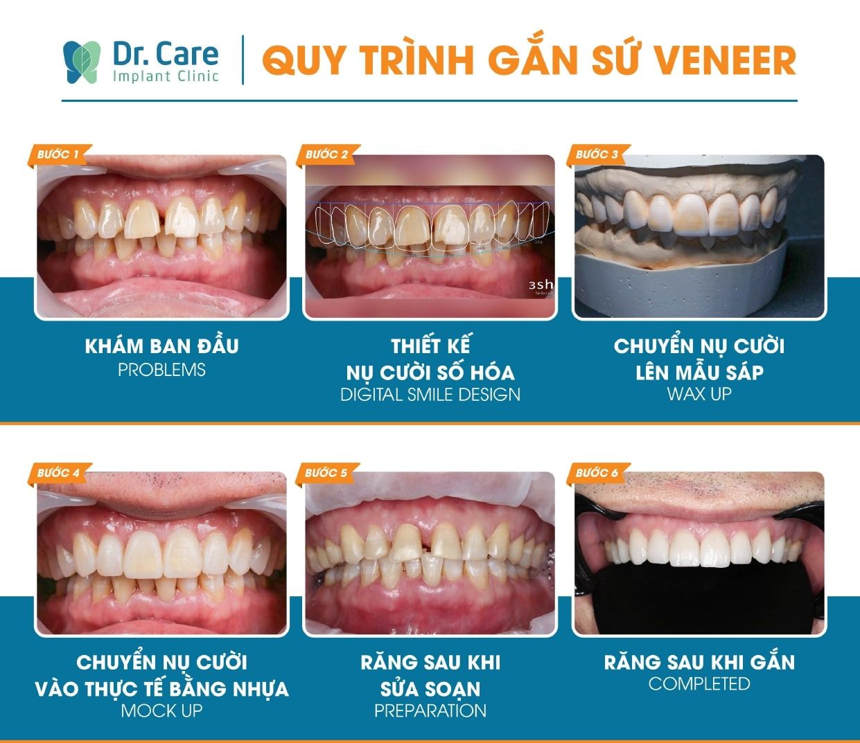 Quy trình dán sứ Veneer Emax tại Dr Care