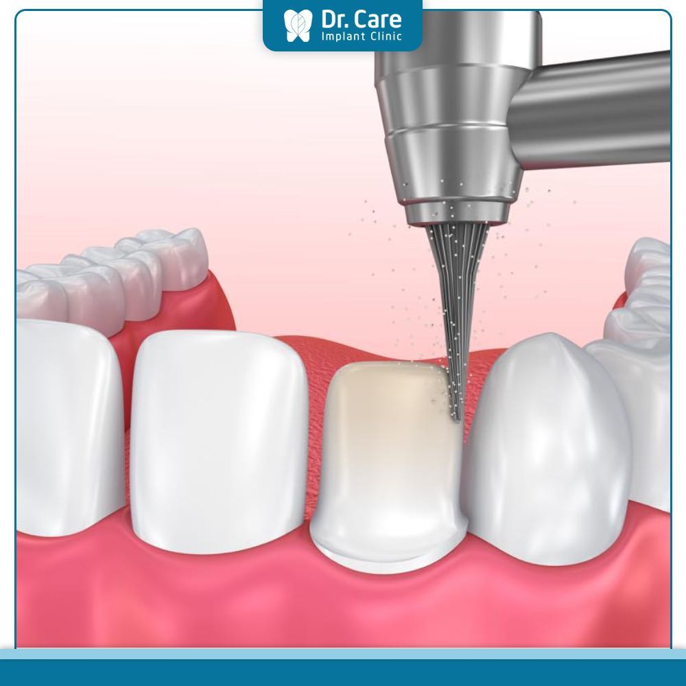 Các phương pháp làm răng sứ cho cả hàm hiện nay