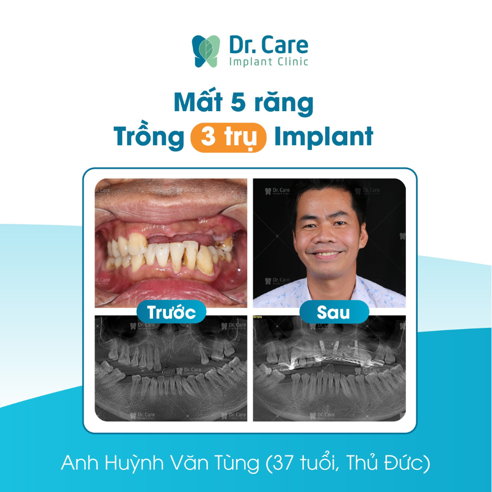 Bảng giá trồng răng Implant chuẩn y khoa tại Dr. Care