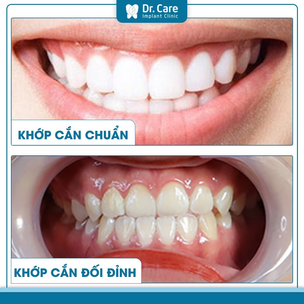 Khớp cắn đối đầu (khớp cắn đối đỉnh) là gì?