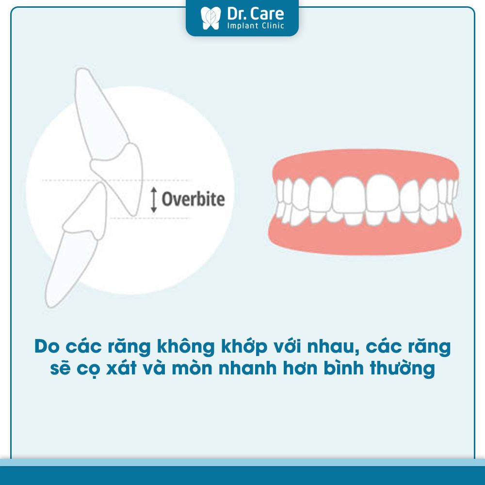 Khớp cắn đối đầu có nguy hiểm không?