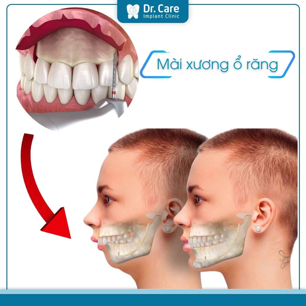 Mài gồ xương ổ răng là gì?