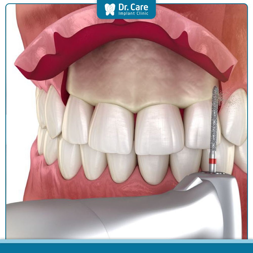 Mài xương ổ răng có đau không, có ảnh hưởng gì không?