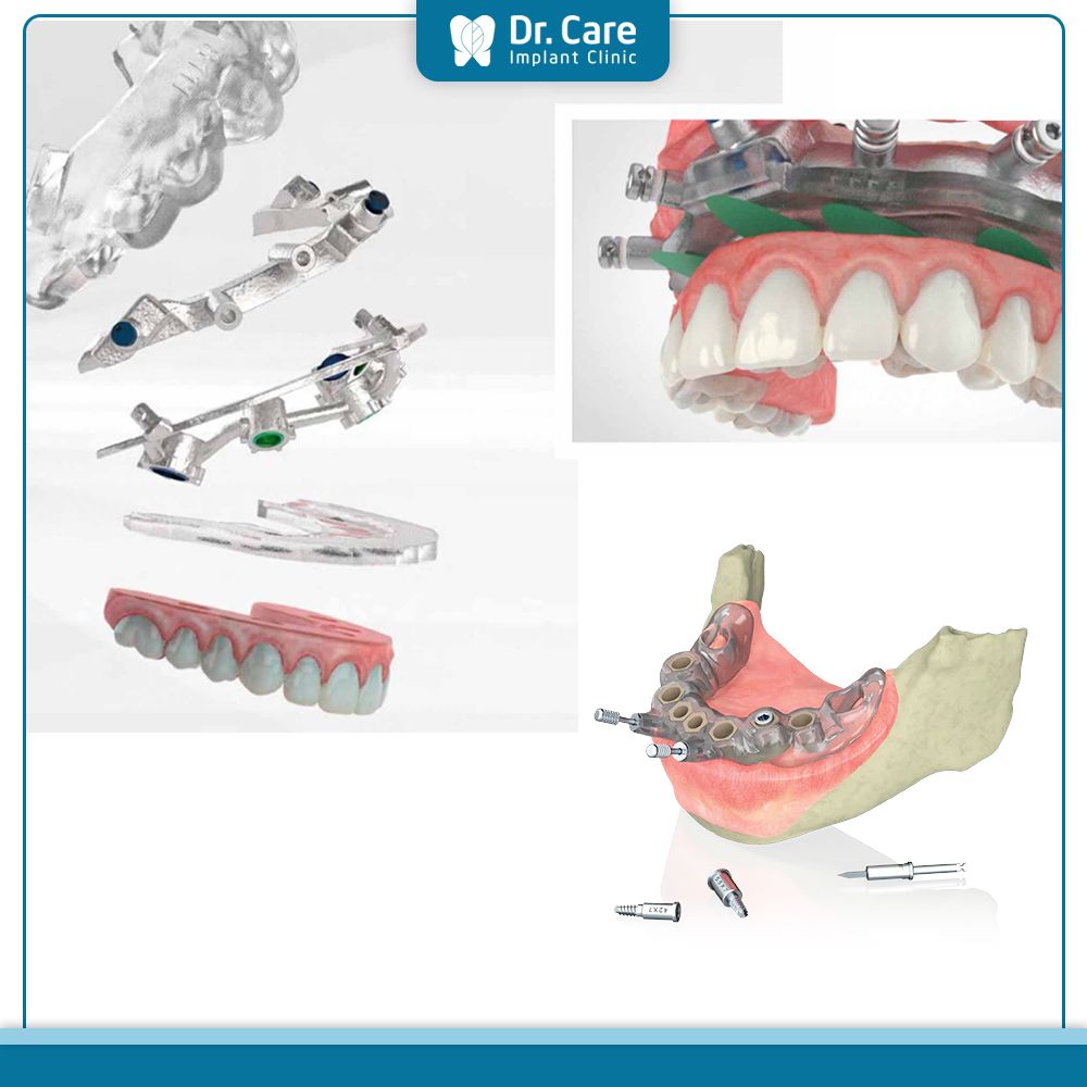 Các câu hỏi thường gặp khi dùng máng hướng dẫn phẫu thuật Implant