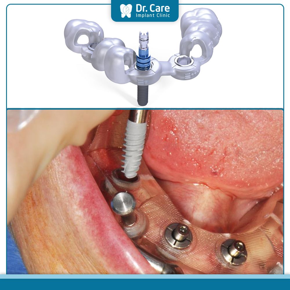 Ưu điểm của máng hướng dẫn phẫu thuật là gì?