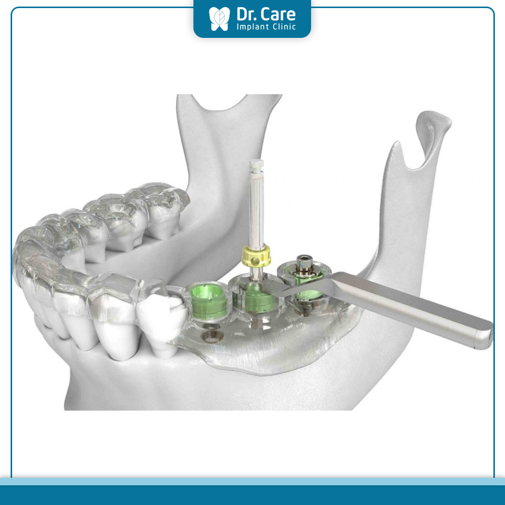 Tìm hiểu máng hướng dẫn phẫu thuật Implant là gì?