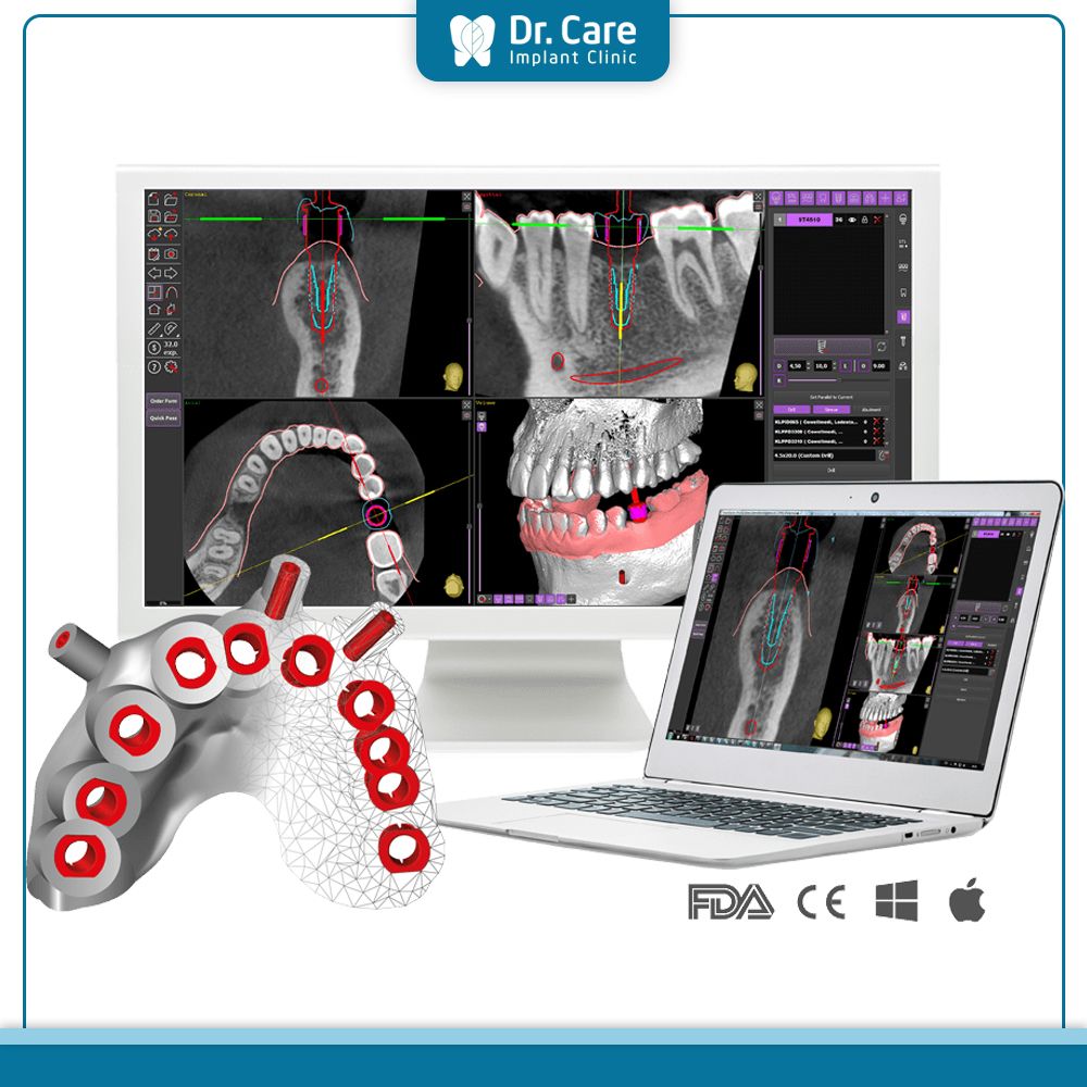 Lập kế hoạch điều trị với kỹ thuật số, máng hướng dẫn phẫu thuật khi cấy ghép Implant