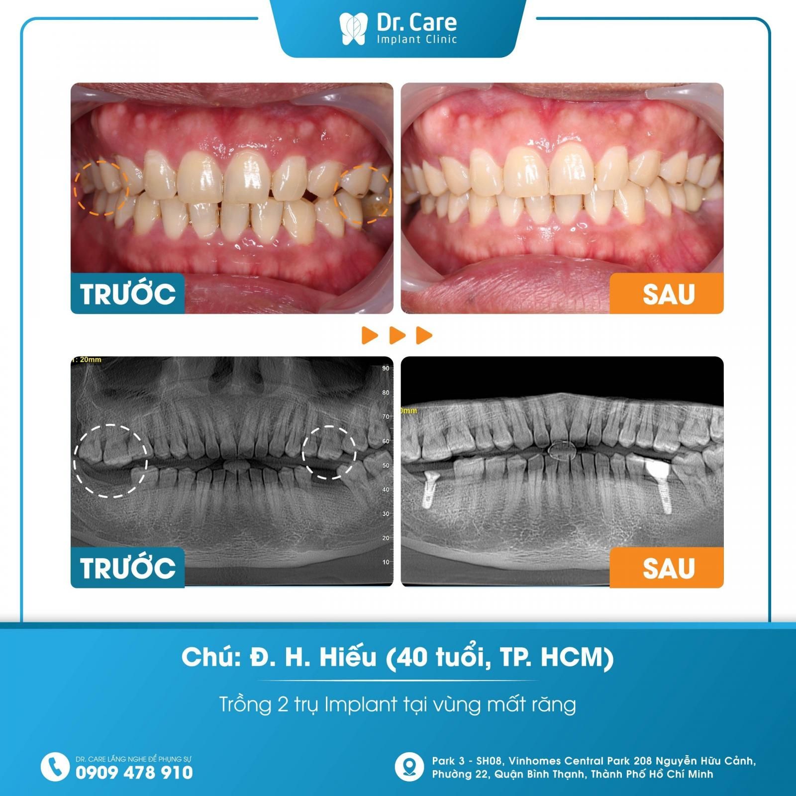 Tại sao cần phải điều trị lệch khớp cắn càng sớm càng tốt?