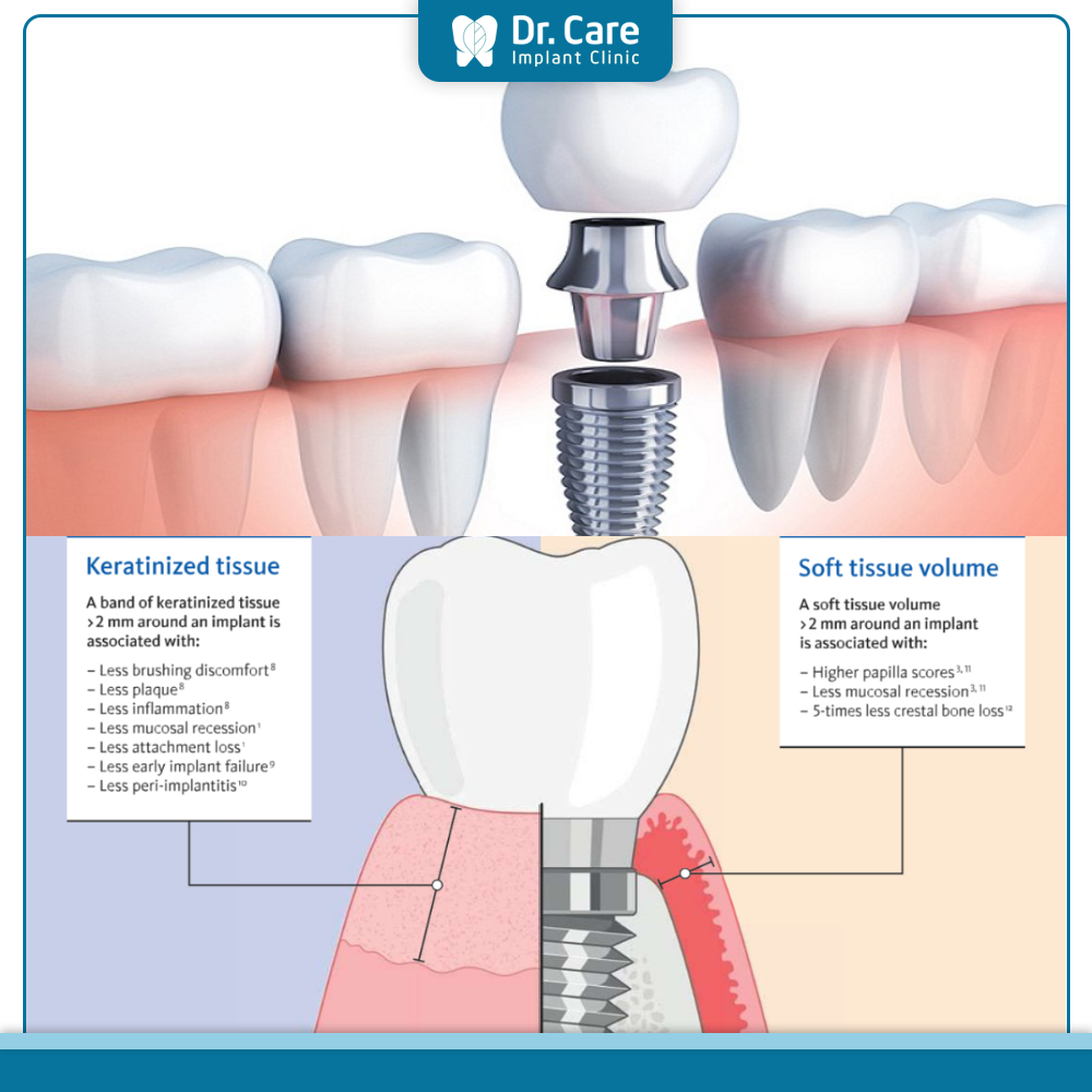 Mô mềm lý tưởng quanh Implant cần đạt điều kiện nào?