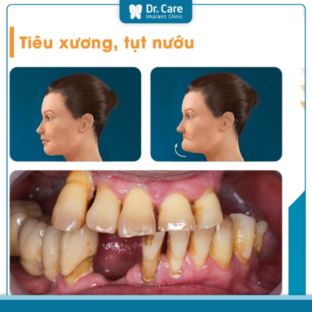 Vấn đề về mô mềm cần phải lưu ý trước khi thực hiện trồng răng Implant