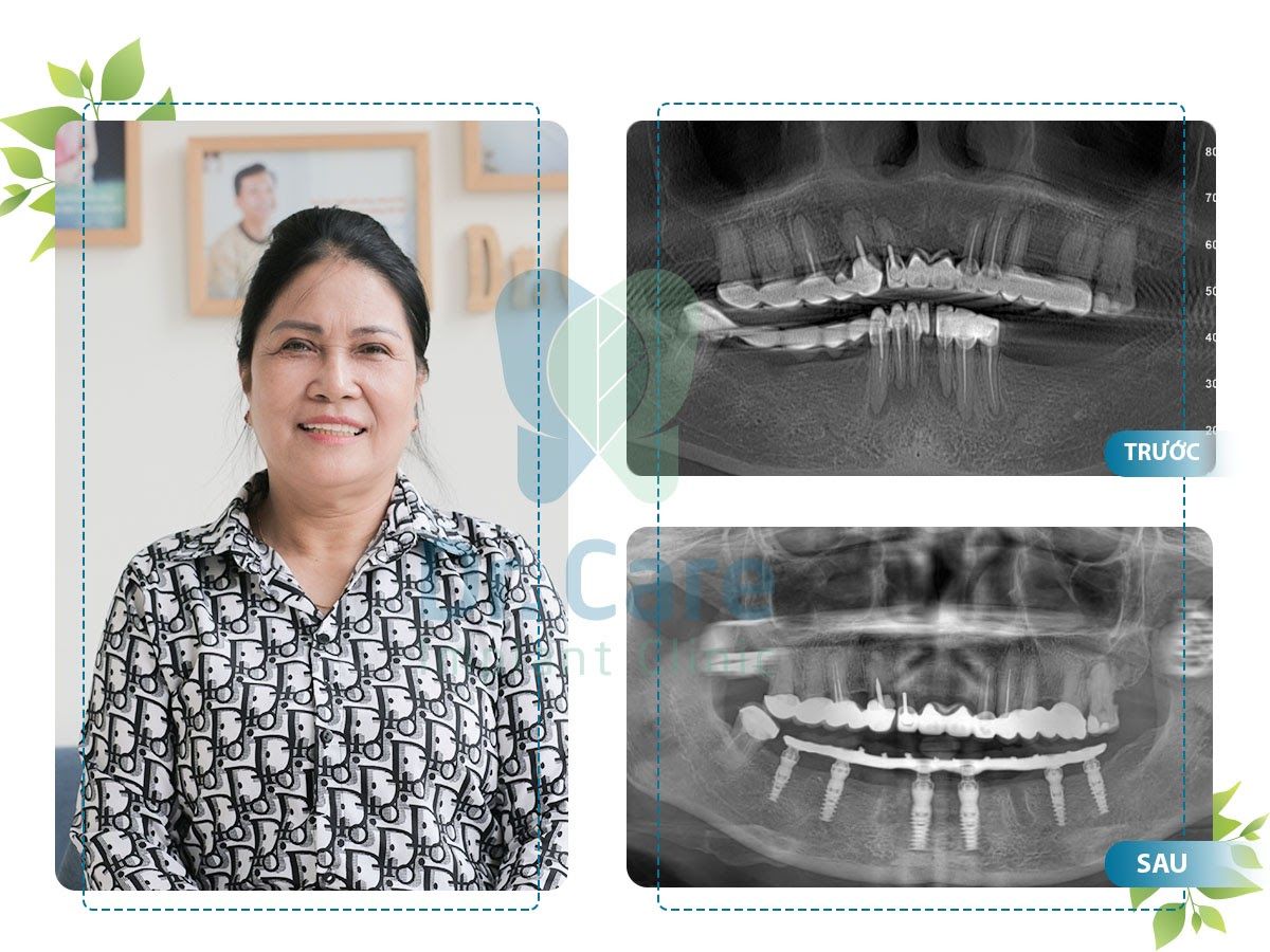 Mất răng lâu năm và những lưu ý khi trồng Implant