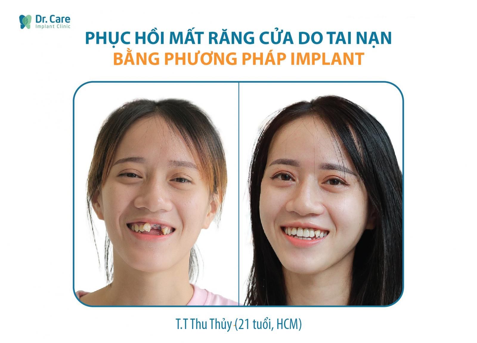 Bệnh nhân gặp tai nạn, chấn thương nặng khiến gãy răng