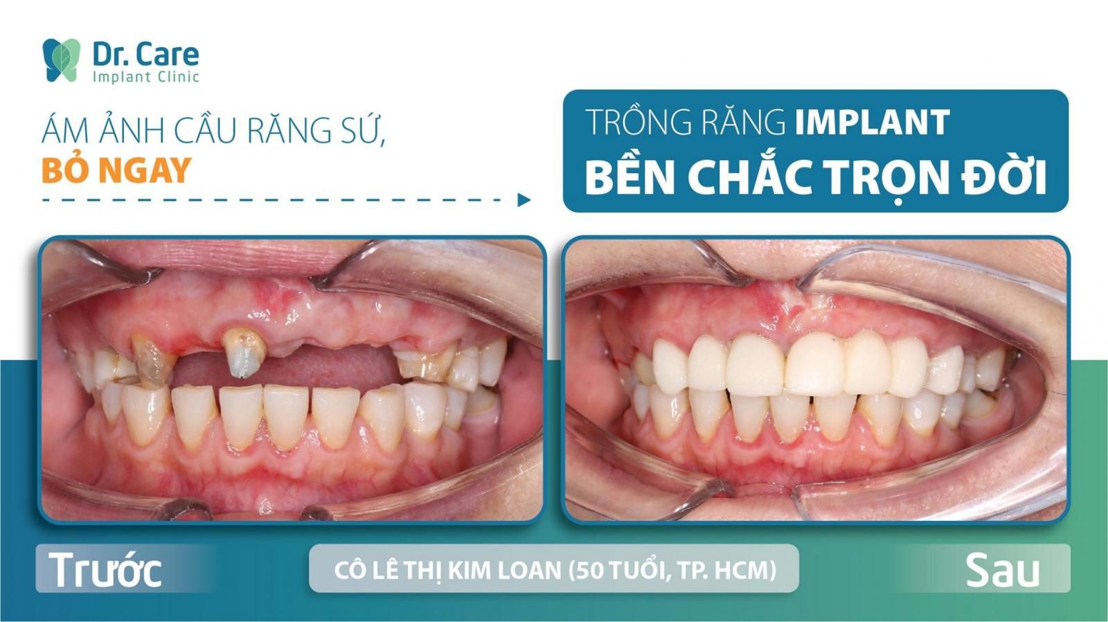 Trồng răng Implant khắc phục tối ưu khi cầu răng sứ bị hư