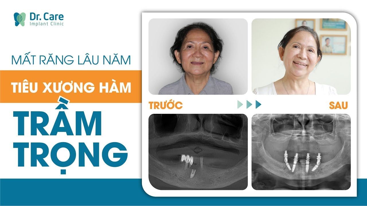 Trồng răng sớm, hạn chế biến chứng nguy hiểm