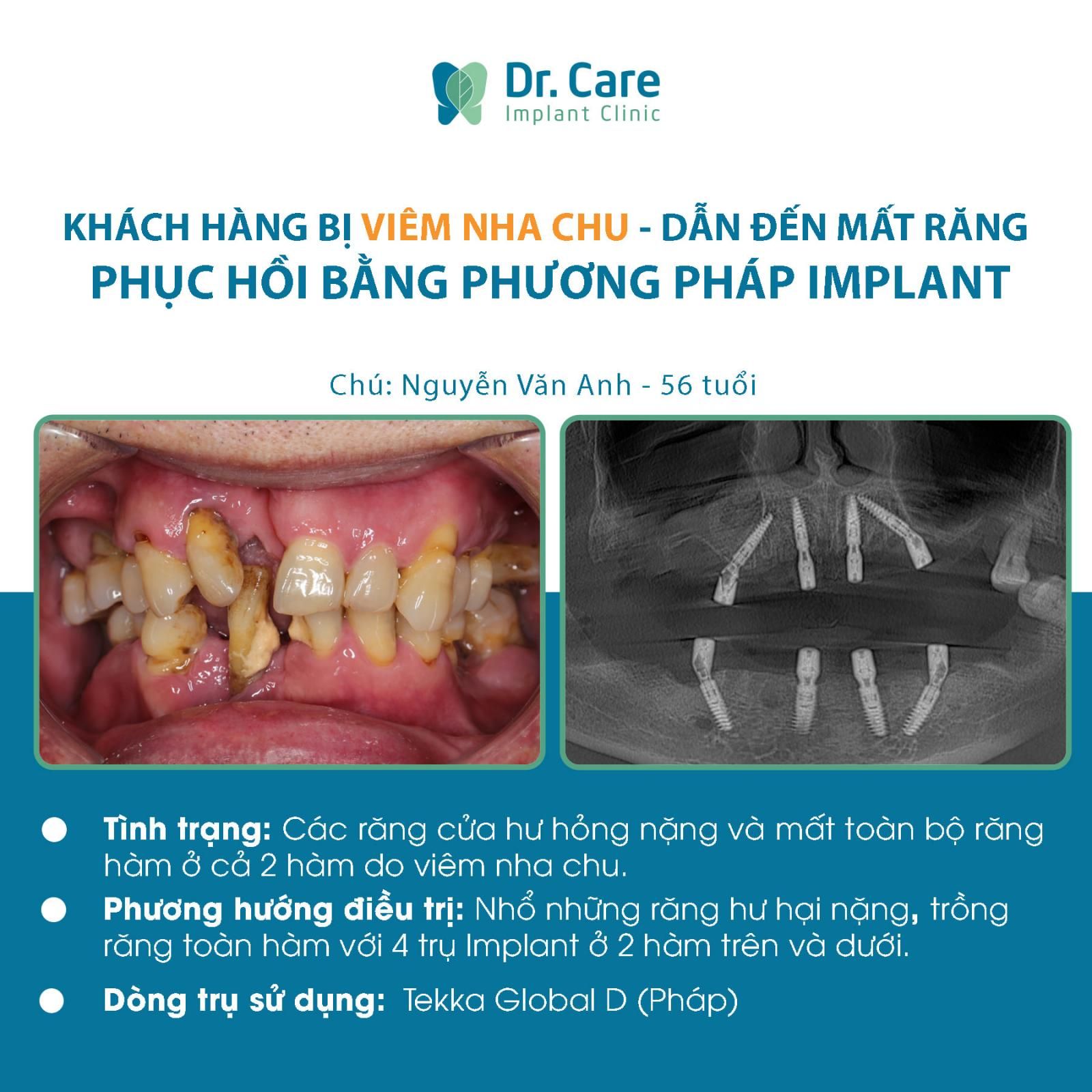 Viêm nha chu - bệnh lý răng miệng nguy hiểm gây nguy cơ mất răng hàng loạt