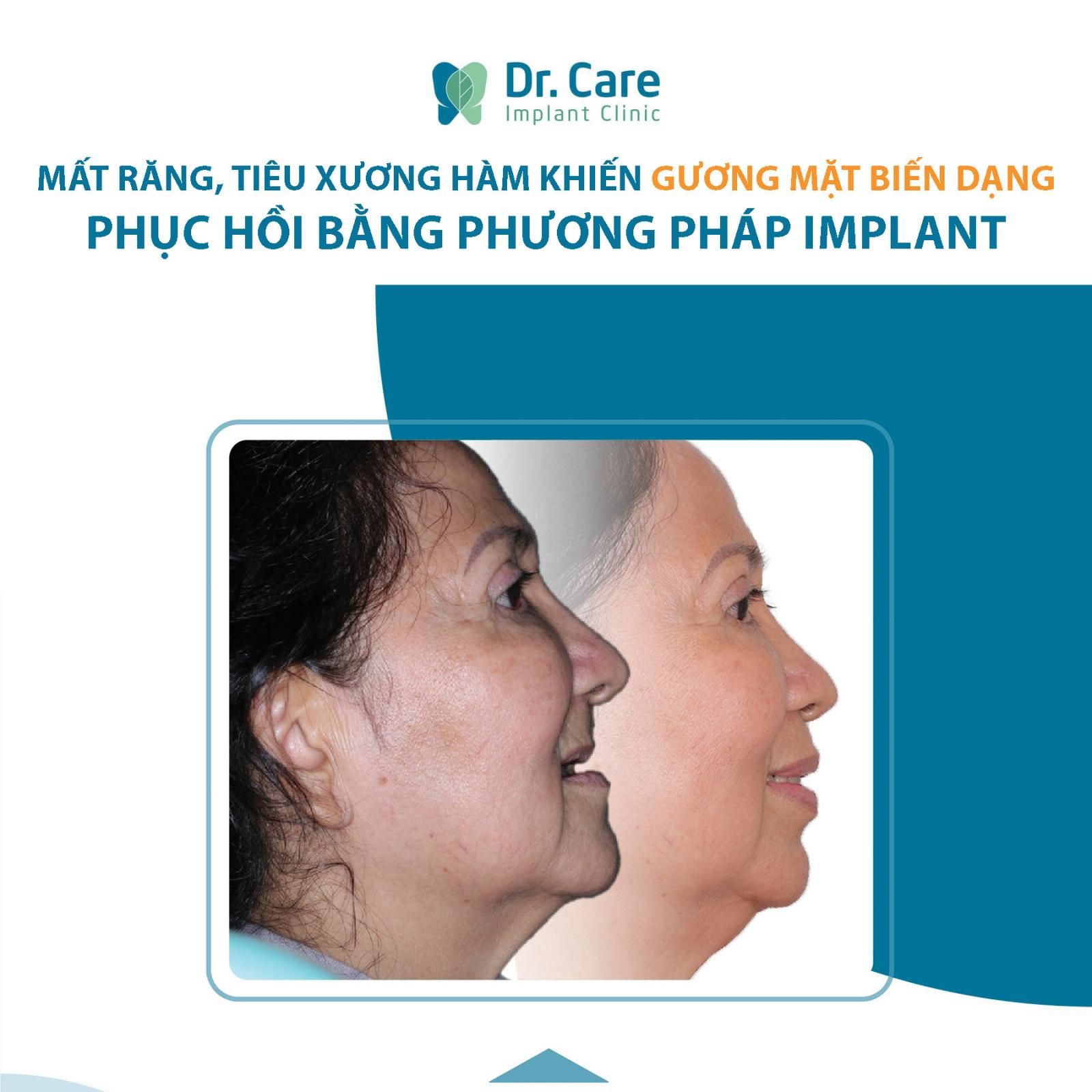 cấy ghép implant giúp phục hồi mất răng, tiêu xương hàm