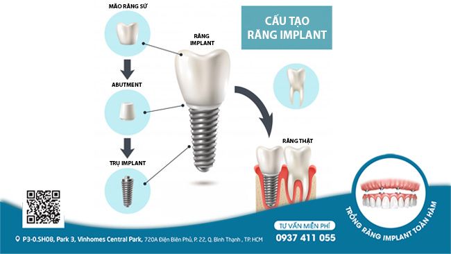 Răng Implant có cấu tạo gần như răng thật, giúp cô chú ăn nhai bền chắc