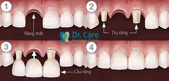 độ bền của cầu răng sứ