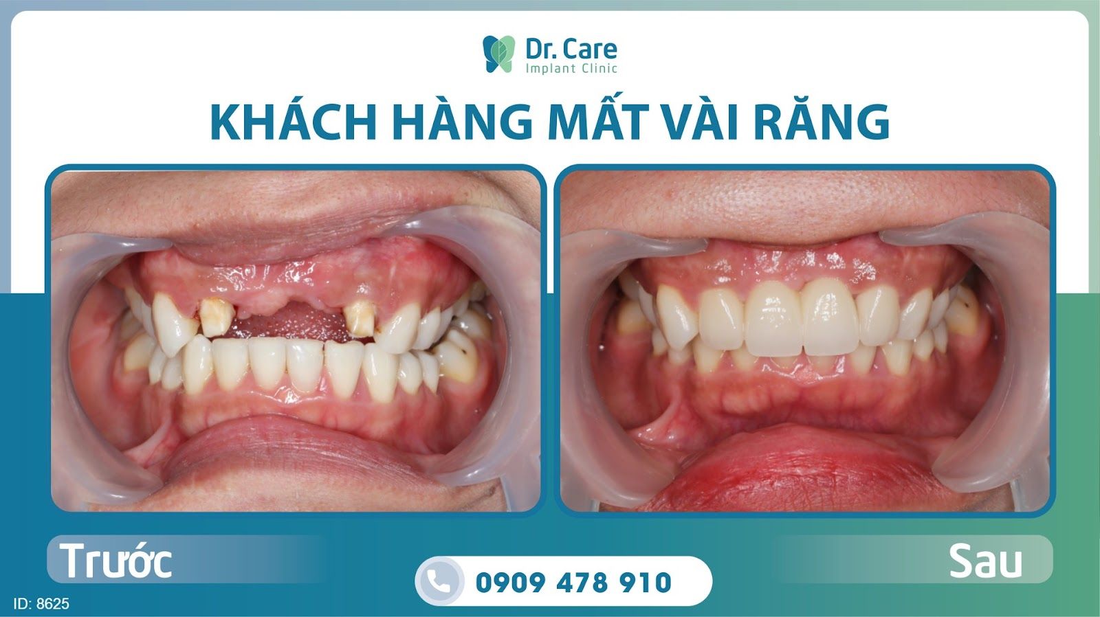 Trồng răng Implant phục hồi mất răng thay cho cầu răng sứ