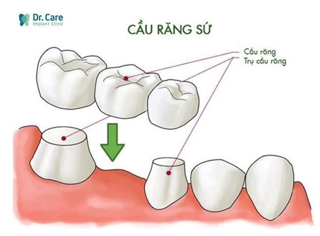 cầu răng sứ là gì