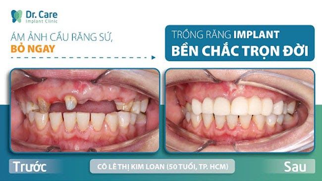 Làm cầu răng sứ giá bao nhiêu dựa vào những ưu nhược điểm nào để đánh giá