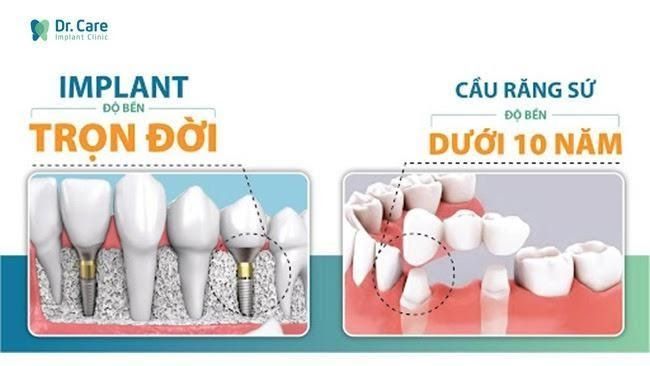 trồng răng implant bền chắc, tuổi thọ lâu