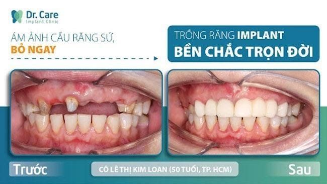 Làm thế nào hạn chế việc làm cầu răng sứ bị viêm lợi?