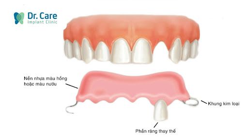 Mất răng số 5 trồng lại bằng cách nào?