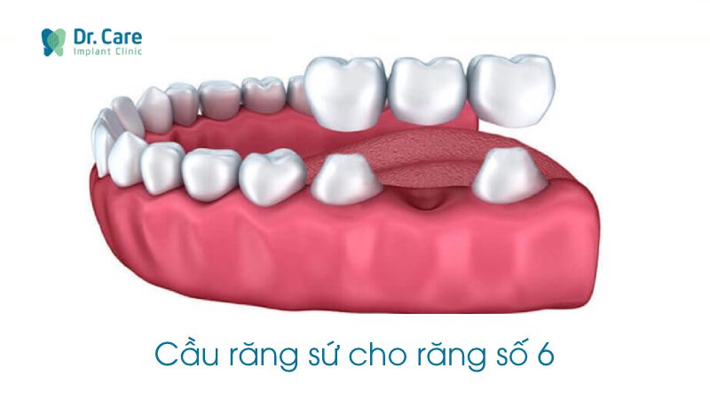 Trồng răng số 6 bằng cầu răng sứ