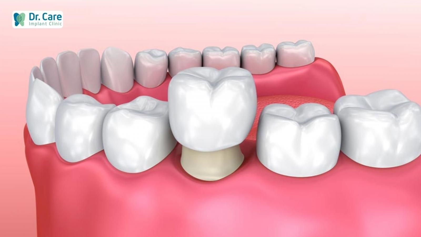 Bọc răng sứ là gì?