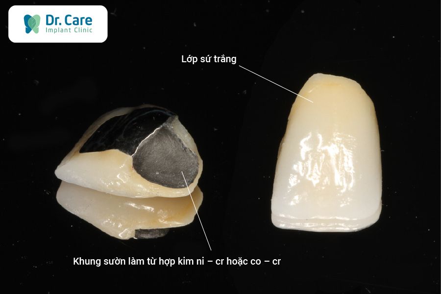 Tìm hiểu về răng sứ kim loại thường